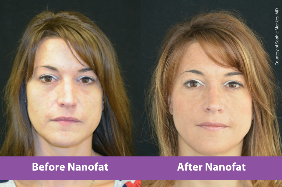 Subcutaneous Injections of Nanofat Adipose-Derived Stem Cell Grafting in Facial Rejuvenation